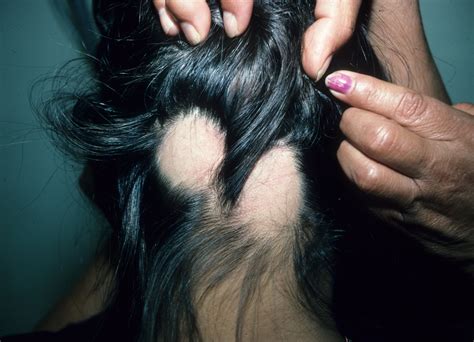  They may collect hair from other areas, or multiple areas, so they do not leave a bald spot